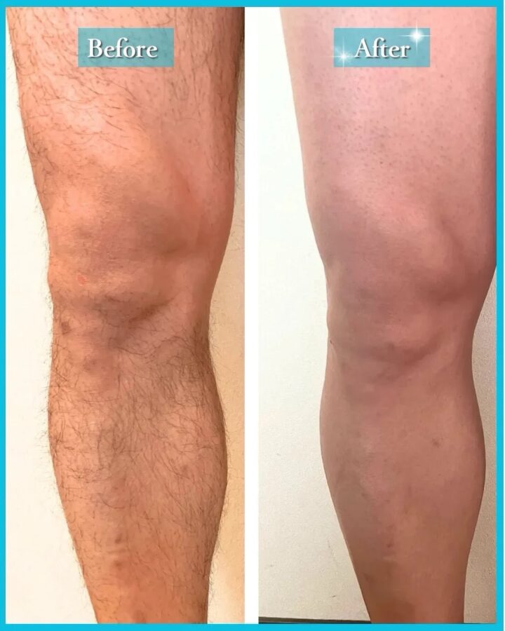 メンズ全身脱毛のビフォーアフター公開|福岡県八女市で人気の脱毛サロンつるりの画像