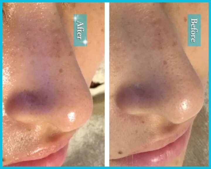 鼻の黒ずみ毛穴ビフォーアフター|毛穴洗浄でいちご鼻ケア|福岡県八女市の画像