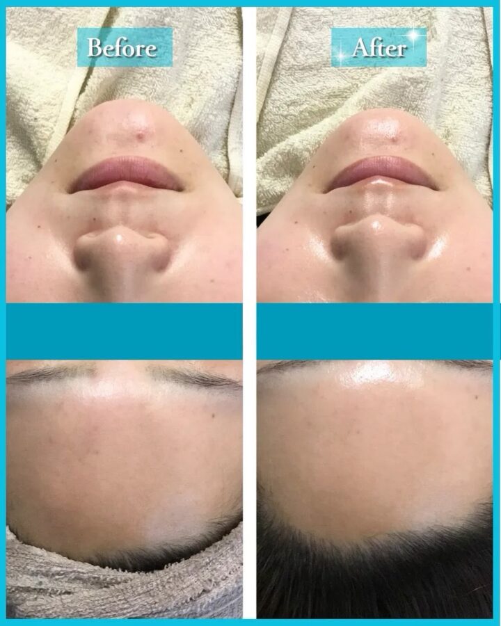 【八女市 小顔フェイシャル】パイラバースト×ラジオ波×ハンドで叶える本格リフトケアの画像