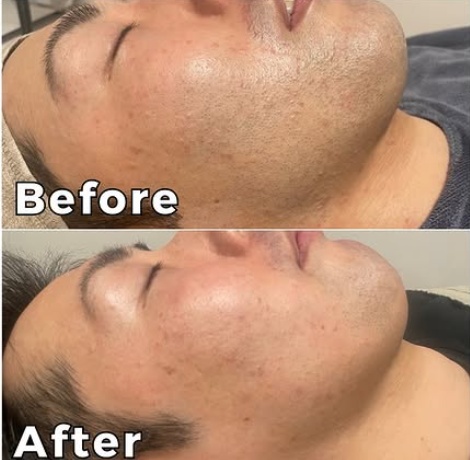 八女市でヒゲ脱毛なら「つるり」!劇的ビフォーアフター公開の画像