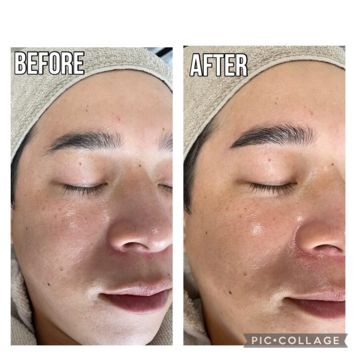 福岡県八女市で眉毛革命!ハリウッドブロウリフトの劇的ビフォーアフターの画像