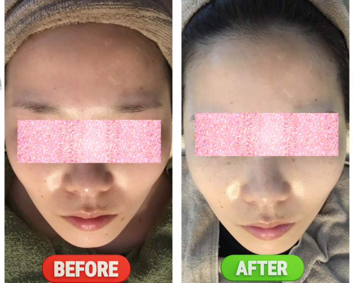 八女市で光フォトフェイシャルなら「つるり」肌質改善ビフォーアフターの画像