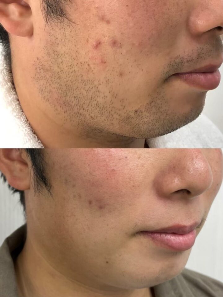 【八女市】メンズヒゲ脱毛のビフォーアフター|頬〜フェイスラインの変化|脱毛サロンつるりの画像